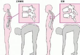 强直性脊柱炎的症状