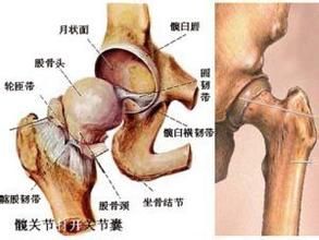 什么是股骨头坏死原因