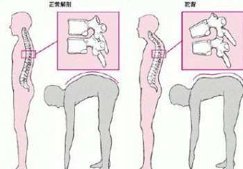 强直性脊柱炎自我护理措施有哪些