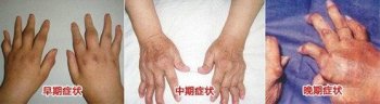 如何判断风湿和类风湿